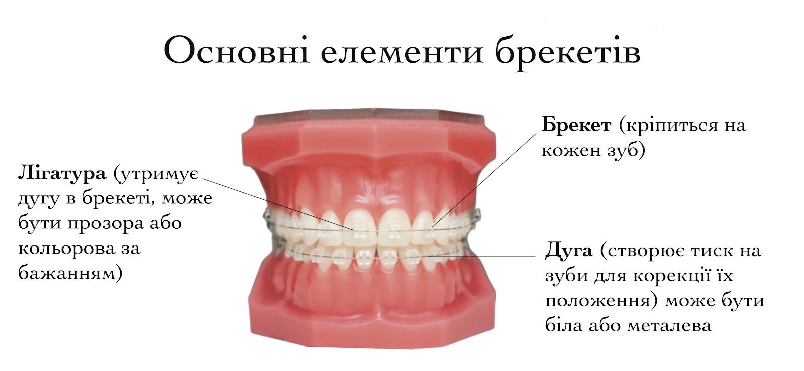 Елементи брекетів