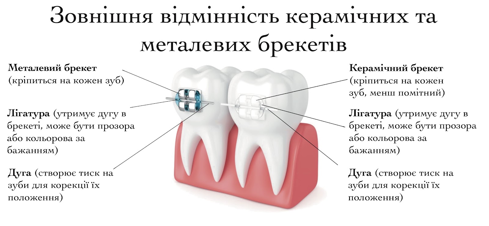 Комбіновані брекети