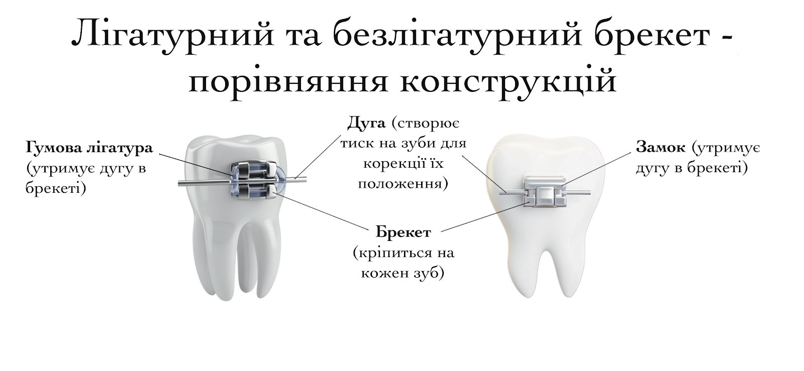 Металеві брекети